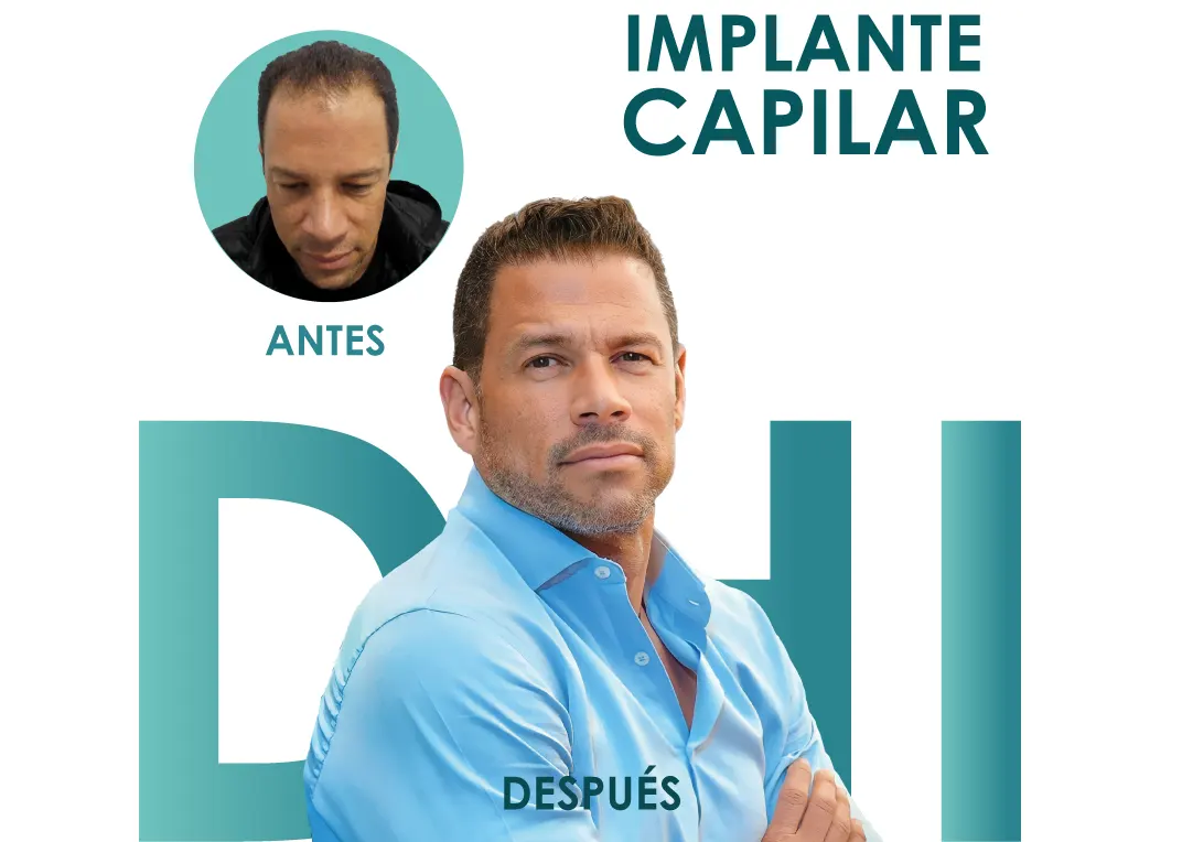 Capillary implant